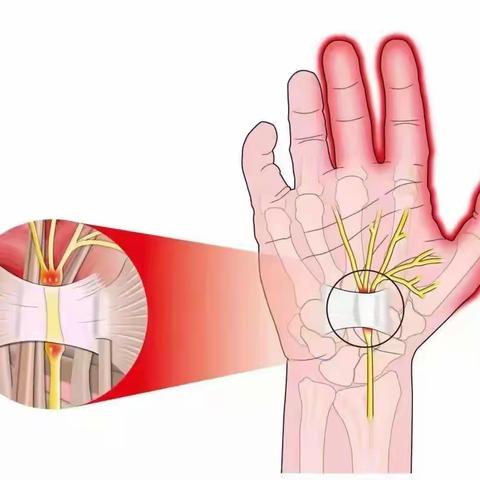 超声引导下针刀精准松解治疗腕管综合征