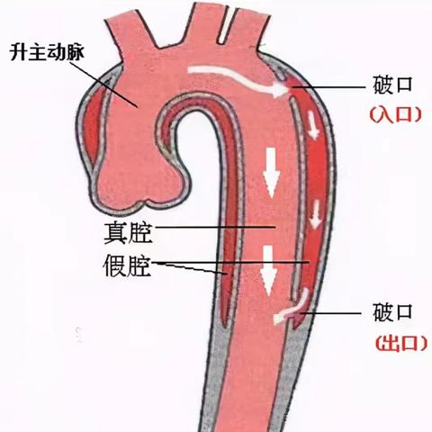 【多科联动】长治市屯留区人民医院多学科联合成功救治一名主动脉夹层患者