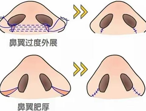 韩国鼻翼缩小哪家医院最好？网友推荐梦想、TS、必当归、爱护