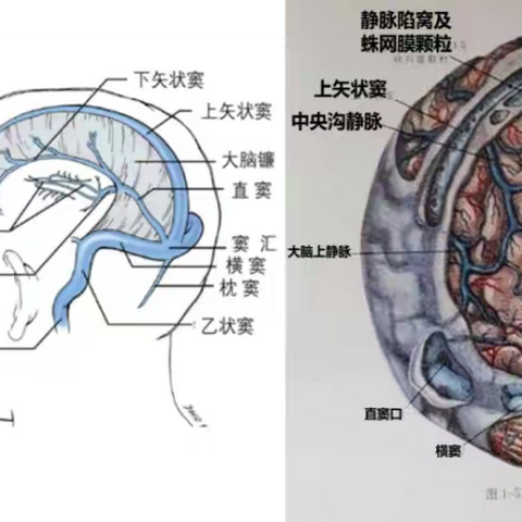 【精雕细琢•精益求精】 ——颅内矢状窦旁脑膜瘤显微切除术