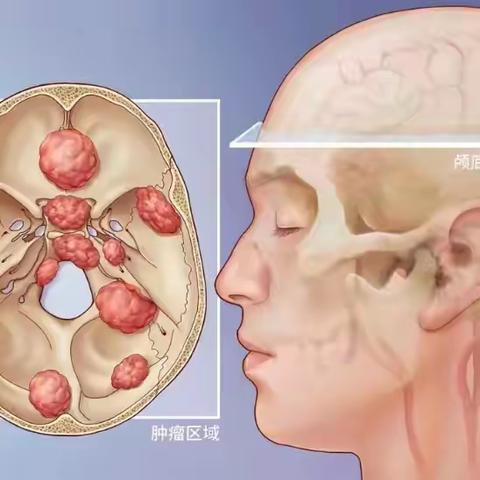 【精准导航•微创未来】 ——机器人辅助下脑内深部肿瘤显微切除术