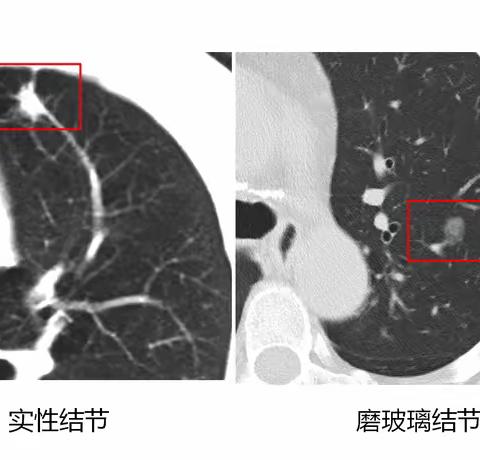 上海大咖继续解决您的问题—本月肺结节门诊如约而至