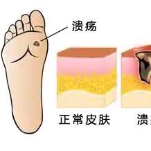 【微科普】容易被忽视的皮肤溃疡