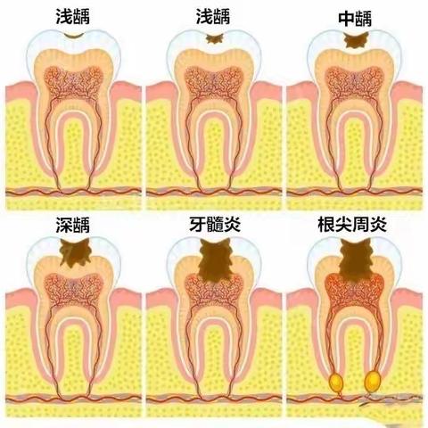 （作炜口腔）黑洞警报，蛀牙了可以不补牙吗？