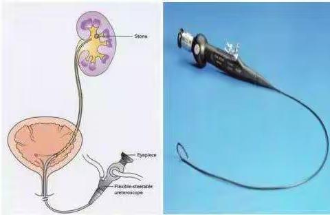 太原西山医院泌尿外科 再次成功实施输尿管软镜下钬激光碎石术