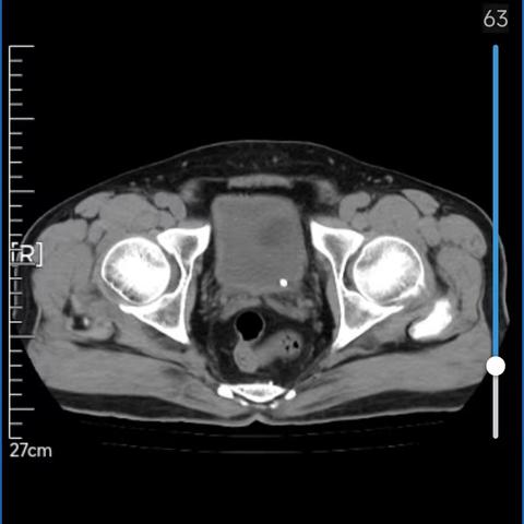 结石患者的福音！“王炸组合”再创医疗奇迹