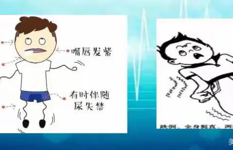 癫痫健康教育20230530164207