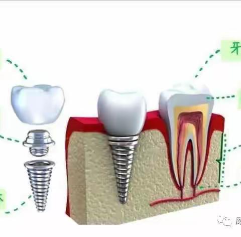 种植|种植牙的流程