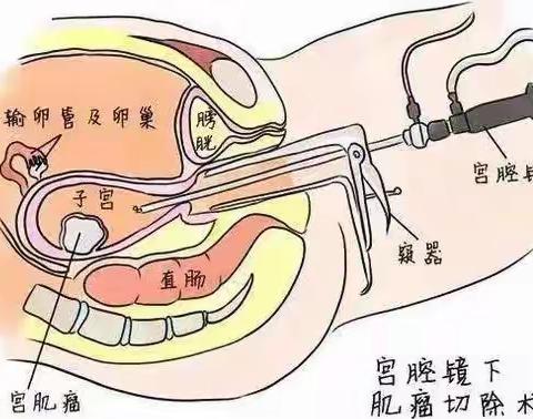 甘肃医学院附属医院妇科日间手术优势