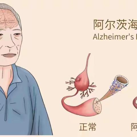 【大院社区新时代文明实践站】抵御老年痴呆 守护美好晚年