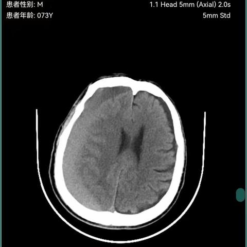 【周医·神经外科】硬膜下血肿，无需舍近求远！