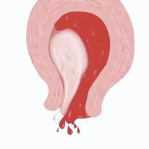 流产不全只会清宫？OUT了！