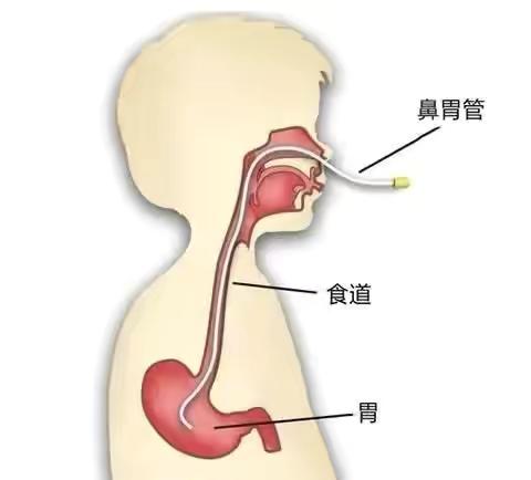 临床中困难胃管置入技巧及注意事项