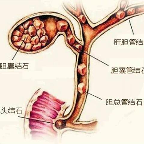 胆石病专科门诊开诊了