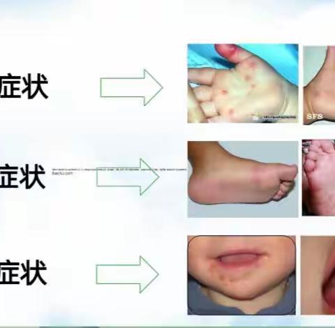 用心呵护——睿卡儿童成长学院 传染病 手足口病  应急演练