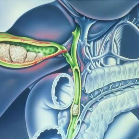 医学科普丨胆结石一定要做手术吗？