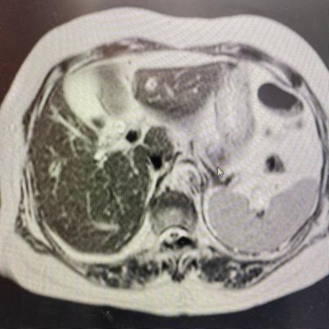 临床纪实丨一例腹腔镜联合胆道镜下活体胆道蛔虫取出术