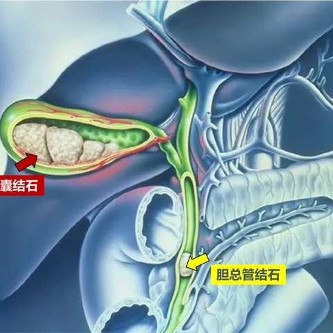 临床纪实丨双镜联合一站式结局胆总管结石合并胆囊结石