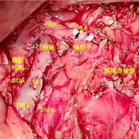 我院多学科密切协作为一位高龄慢性心衰患者顺利实施胰腺巨大肿瘤切除术并康复