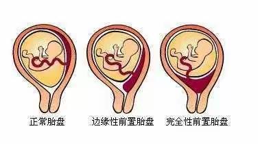 全力以赴、用爱托起生命的希望—凶险性前置胎盘化险为夷