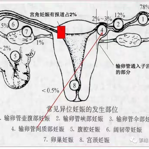 宫外孕的科普知识