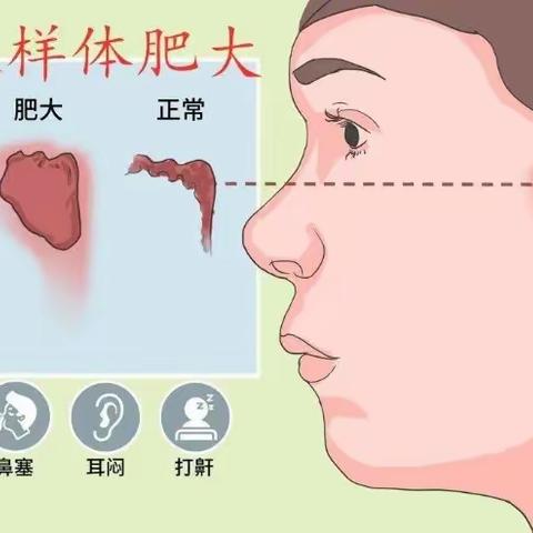 儿童腺样体肥大中医调理有妙方