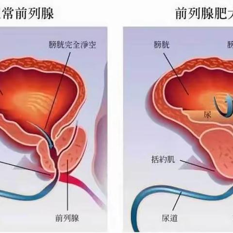 泌尿科普小知识：前列腺增生