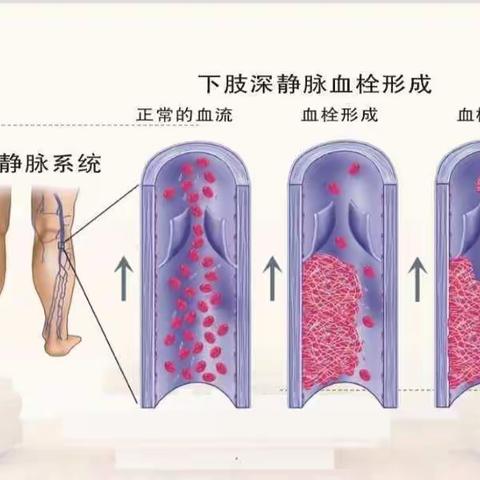 外三科护理查房之下肢深静脉血栓篇