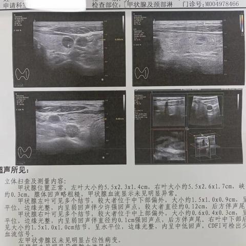 西丰县第一医院普外科团队成功完成一例甲状旁腺肿瘤根治术