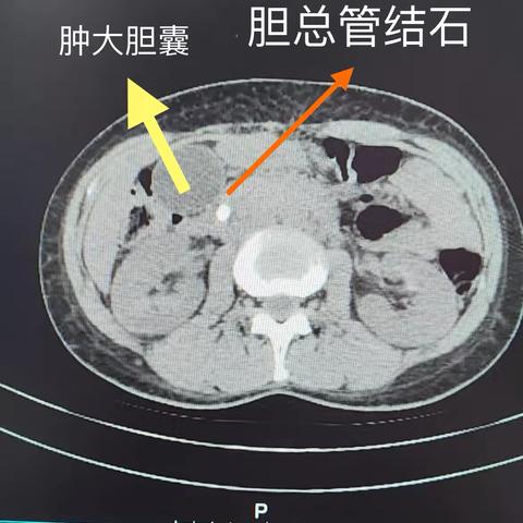 西丰县第一医院普外科成功完成腹腔镜下胆囊切除+腹腔镜胆总管探查术（LC+LCBDE）