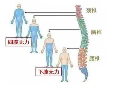 脊髓损伤患者康复