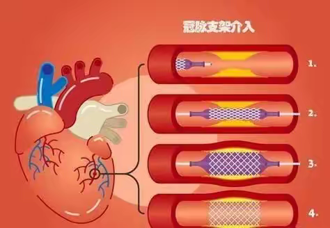 心脏介入护理健康科普之你问我答