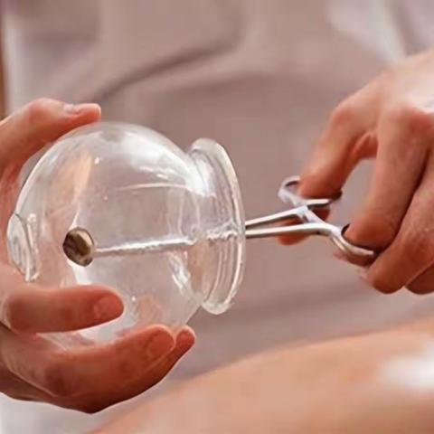 邱县中医院脑内科中医科特色疗法——拔罐