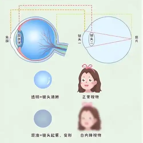 【职业病科普】别让眼睛"亮瞎"！职业性放射性白内障防坑指南