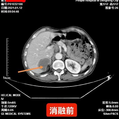 零下150℃，“氩氦冷冻消融”轻松杀灭肿瘤