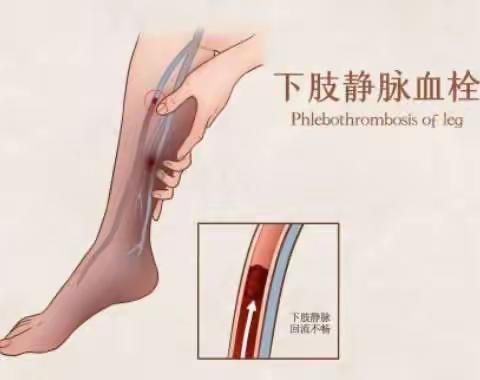 血管“堵车”→下肢静脉血栓！