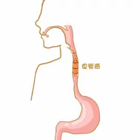 食道癌放疗别轻视，放疗前后须注意