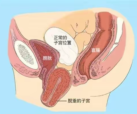 腹腔镜下“子宫腹壁悬吊术”治疗子宫脱垂