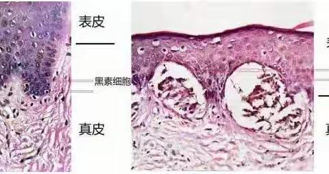 人各有“痣”，想要祛痣，您知道多少？