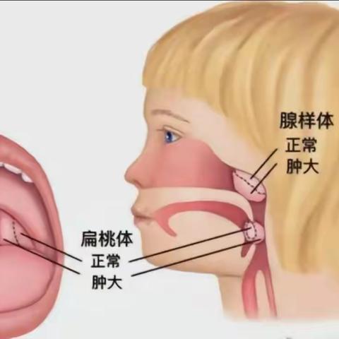 【医讯】山丹同和医院开展适龄儿童扁桃体免费筛查活动！