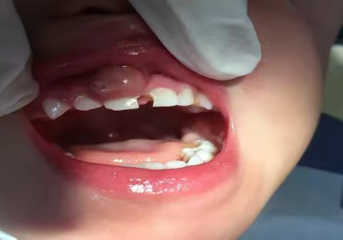 卓维雅口腔早报分享“为什么牙龈长脓包消了还反复长？”