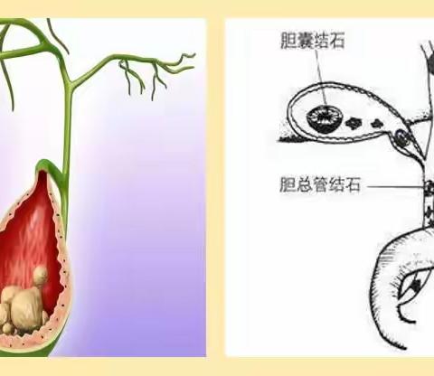 胆结石和胆囊息肉——解答您的胆囊困惑