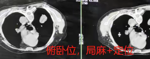 肺穿刺活检，诊断肺癌，紫阳中医院11楼，内二科