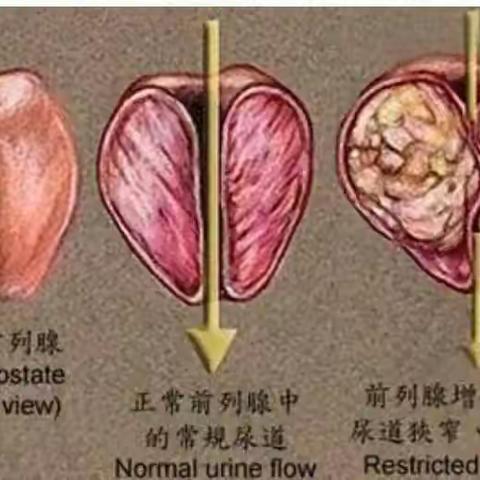 固始县中医院泌尿外科新技术——经超声引导下经会阴前列腺穿刺活检术