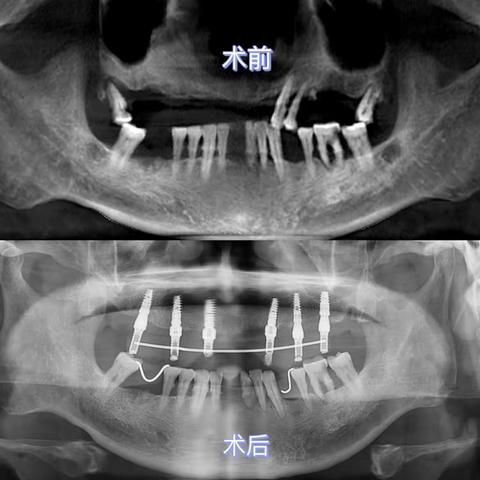 种植牙让生活更有滋味！