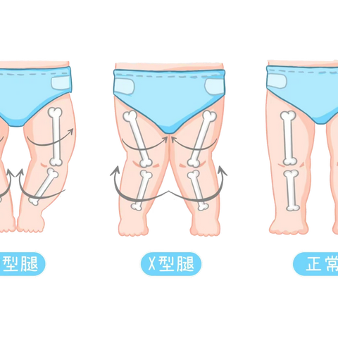 宝宝O型、X型腿如何判断？