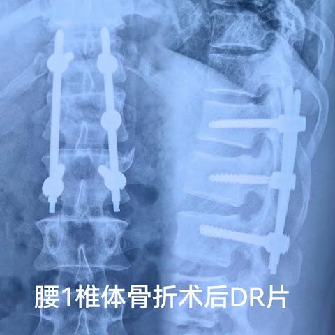 胸腰椎骨折治疗新概念一一经皮椎弓根内固定术