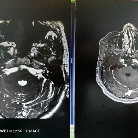 呈贡病区27床术后汇报