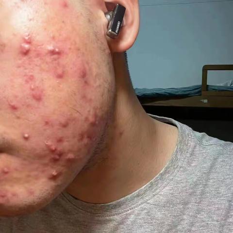 痤疮的困扰，真实的案例