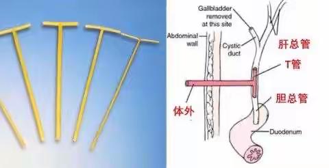 T管如何居家护理